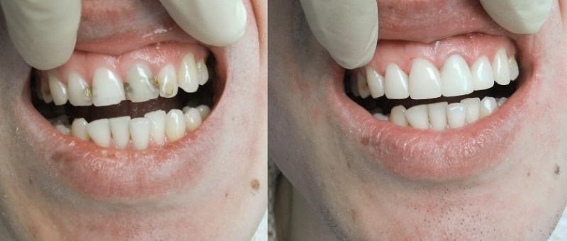 Эстетическая реставрация зубов- 36 ч.