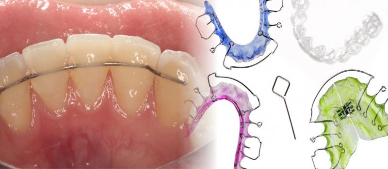 Ошибки и осложнения при ортодонтическом лечении - 36 ч.